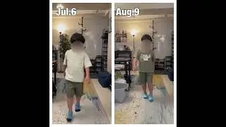 DMD treatment record after 4 months #dmd #duchenne #duchennemusculardystrophy