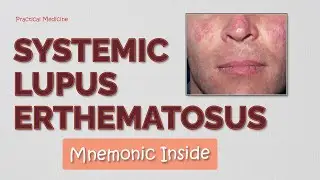 Systemic Lupus Erythematosus | SLE | Pathophysiology, Diagnosis, Diagnostic Criteria & Management