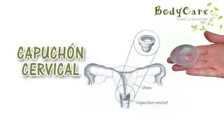 Capuchón cervical