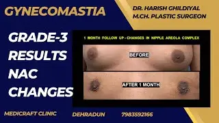 Gynecomastia surgery in dehradun I Gynecomastia results I Changes after Male Boobs surgery