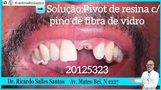 Quebrei meu dente da frente como arrumar na hora?