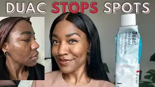DUAC Gel For Acne | Benzoyl Peroxide & Clindamycin | My Experience - DOES DUAC WORK?