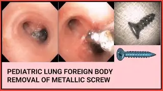 Pediatric Lung Foreign Body Removal Of Metallic Screw শিশুর ফুসফুস থেকে স্কু বের হল #BD_ENDOSCOPY