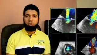 How to measure the 3D-Vena Contracta Area (3D-VCA) for mitral regurgitation