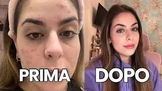 COME HO CURATO L'ACNE- PRODOTTI E STORYTIME