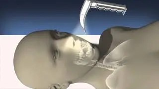 OBP Sure-Scope Lighted Laryngoscope