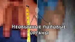 10 People with Unusual Genitals