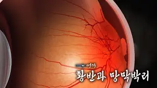 [명의 의학백과📖] 황반과 망막박리