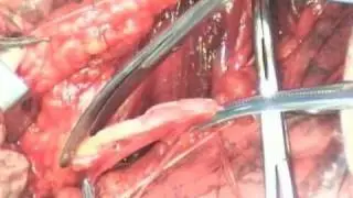 Vaginopexy - Uterine prolapse