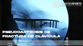 PSEUDOARTROSIS DE FRACTURA DE CLAVÍCULA
