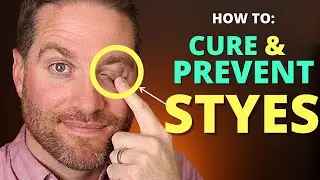 How To CURE And PREVENT STYES: Get Rid Of A Hordeolum (stye) And Chalazion Fast!