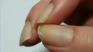 Почему слоятся ногти на ногах и руках?