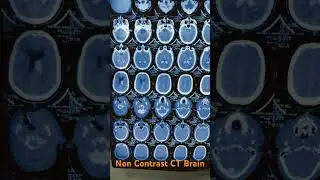 Non Contrast CT brain #medical #ctscan #medicalstudent