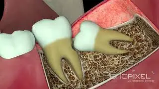 Vídeo 3D Problemas ocasionados por las muelas del juicio - PerioPixel