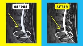 Lumbar Disc herniation L5 S1 Reabsorption in 7 months