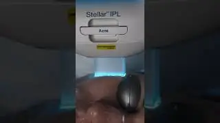 Stellar IPL - новейший аппарат для косметологов