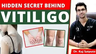 Hidden Secret Behind Vitiligo | How to Cure Vitiligo Naturally & Permanently From The Root Cause