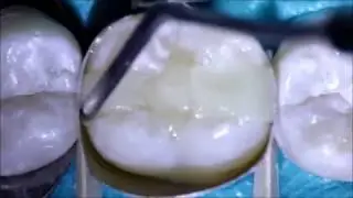 Bulk Fill Composites