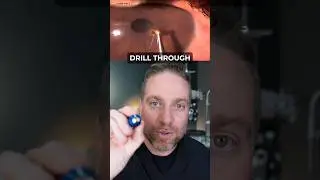 Eye Foreign Body Removed With Algar Brush!
