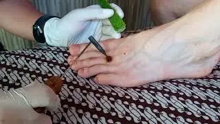 AGNI KARMA FOR WART
