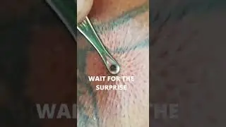 Blackheads & Milia, Big Cystic Acne Blackheads Whiteheads Removal Pimple Popping 