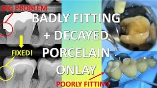 Extremely Difficult Ceramic Onlay Replacement With Emax Using CEREC | Indirect Case #1