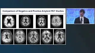 Alzheimer’s Disease Case Conference: The Role of Neuroradiology in Diagnosis and Treatment