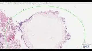 Uterus: Hydatidiform mole Microscopy - Talking slide