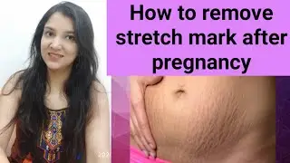 How to remove stretch marks after delivery !! How to remove stretch marks after pregnancy