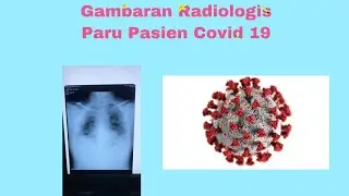 Gambaran Foto thoraks Paru-Paru Pasien covid 19 (Pneumonia Bilateral)
