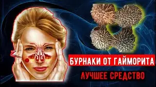 Как использовать бурнаки от гайморита! Лучшее средство от синусита