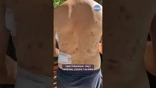 ❤️‍🩹«Мені не було куди тікати»: херсонець потрапив під атаку дрона 🎥Олександр Андрющенко