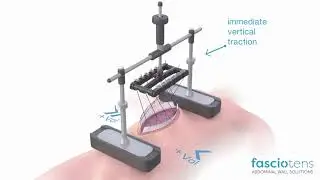 Abdominal wall solutions