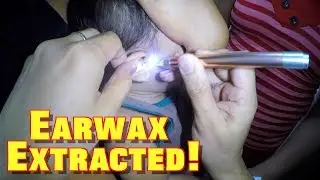 Removing Little Boy's Earwax Using Lighted Ear Curette