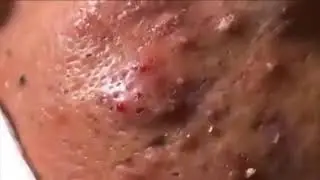 OLHA O TANTO DE CRAVOS NESSE ROSTO!!!🤢🤮 - Vídeos Satisfatórios