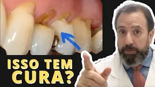 Desgaste no colo dos dentes⎮Causas e Solução ⎮Abfração dentária