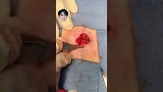 Making a New Bellybutton from Scratch! 