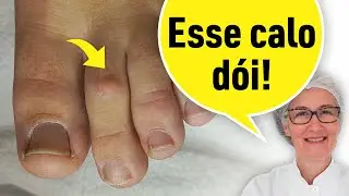 CALO NO SEGUNDO DEDO