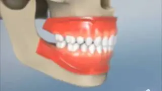Bruxism