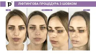Ліфтингова процедура з шовком