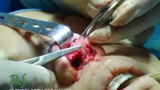 Rhinoplasty With Shield Graft & Alar Rim Graft