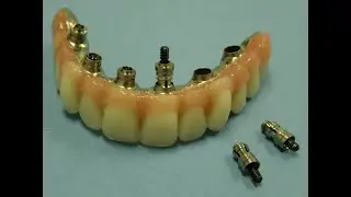 Implant Restoration of an Edentulous Maxilla