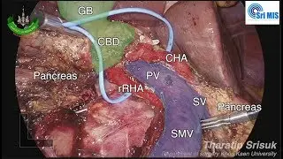 Laparoscopic pancreaticoduodenectomy (Educational nearly uncut): Resection part
