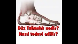 DÜZ TABANLIK/ TABAN ÇÖKMESİ NEDİR? ÇOCUKLARDA NEDEN SIK GÖRÜLÜR?
