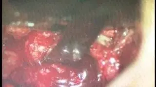 LUMBAR DISC HERNIATION-HÉRNIA DE DISCO