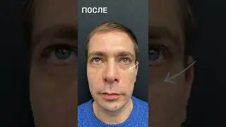Очень ранний срок после бесшовной пластики нижних век - всего 5 дней, но результат уже показательный
