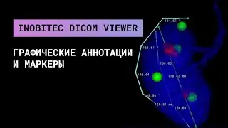 Графические аннотации и маркеры в Inobitec DICOM Viewer