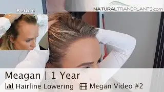 Female Hairline Lowering Hair Transplant 1 Year After | Dr. Matt Huebner (Meagan)