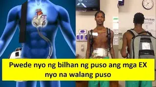 Kauna-unahang Total Artificial Heart transplant naisagawa sa Amerika!