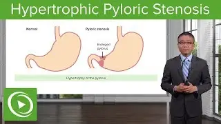 Hypertrophic Pyloric Stenosis – Surgery | Lecturio